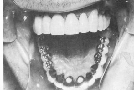 4 Acrylic placed over holes inside central incisors to lock set screws