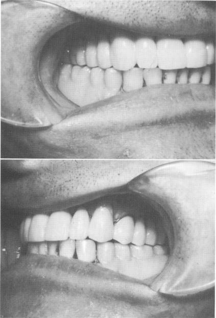 1 Intraoral radiograph reveals two internally threaded ventplants