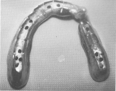 2 Double rail template on maxillary stone model