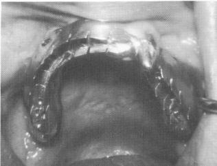3 Template fitted in position using one remaining upper tooth as guide