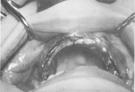 1 Template cemented on upper tooth & pin implants drilled in template
