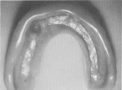 2 Dental pins secured to each other & to double rail by fast cure acrylic