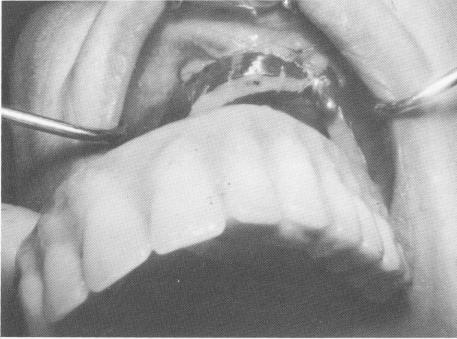 3 Full arch palateless removable denture made to fit on rail template