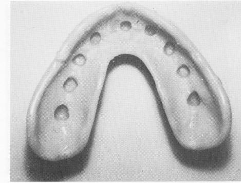 1 Prefabricated palateless denture with holes for pin implants