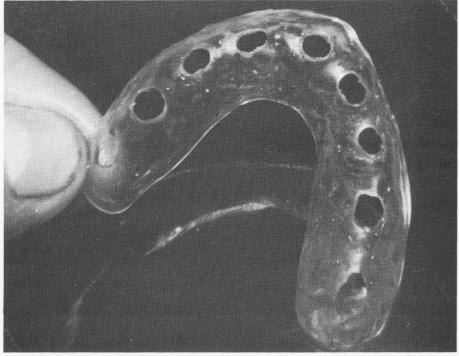 2 Colorless palateless acrylic template with holes for maxillary arch