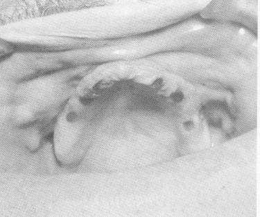 3 Indelible pencil marks made in openings in acrylic template in mouth