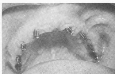 4 Dental pin implants in series of three`s were driven into the bone