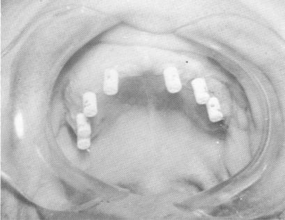 5 Dental pins in upper jaw affixed to each other using Teflon cylinders