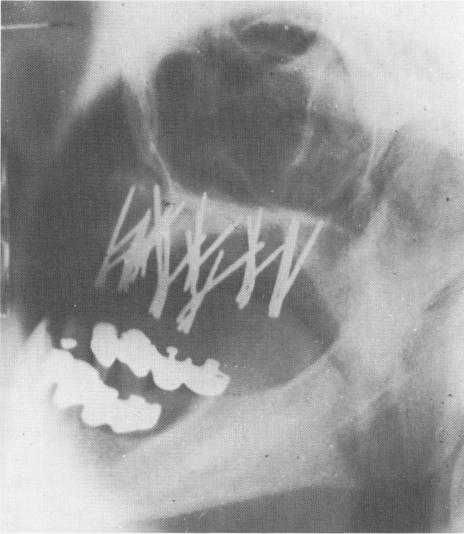 1 Lateral plate roentgenogram showing sections of triplants in maxilla