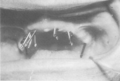 2 Dental pins driven in various directions through soft tissue & bone