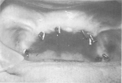 3 Excess length of dental pin implants disked away