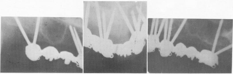 2 X ray shows pins circumventing maxillary sinus & nasal vestibulum