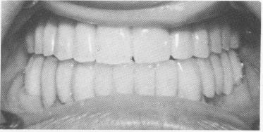 3 Picture of edentulous maxilla with a very shallow ridge