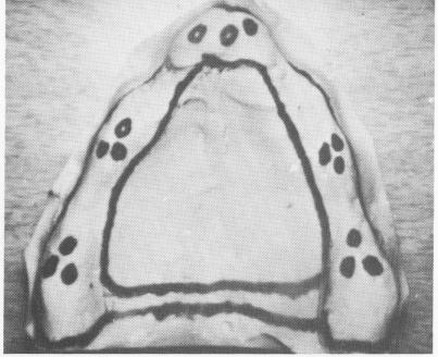 1 Maxillary mesostructure with gold copings joined with connecting bar