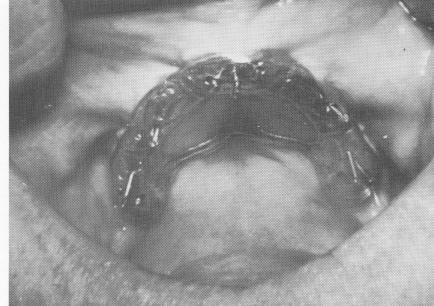 2 Template held in position while dental pins driven through the holes