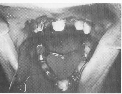 3 Maxillary master stone model poured from elastic impression