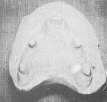 4 Completed maxillary palateless denture with internal clip bars 