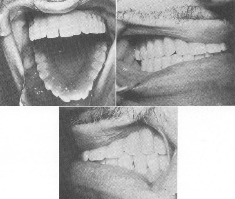 1 Finished case of full arch maxillary palateless denture