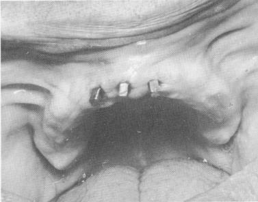 1 Three ventplants placed in maxillary incisor region