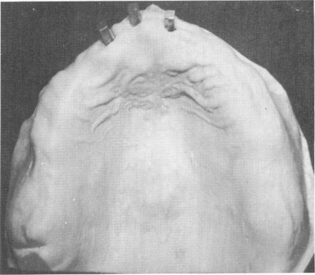 3 Maxillary master model including three duplicate implant shafts poured