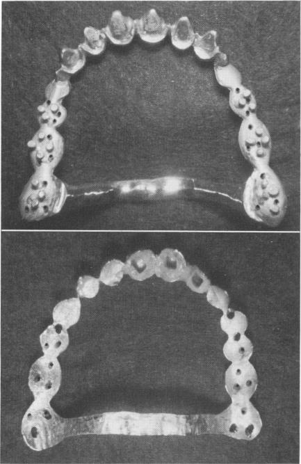4 Template with palatal connecting bar & vertical mushroom pin heads