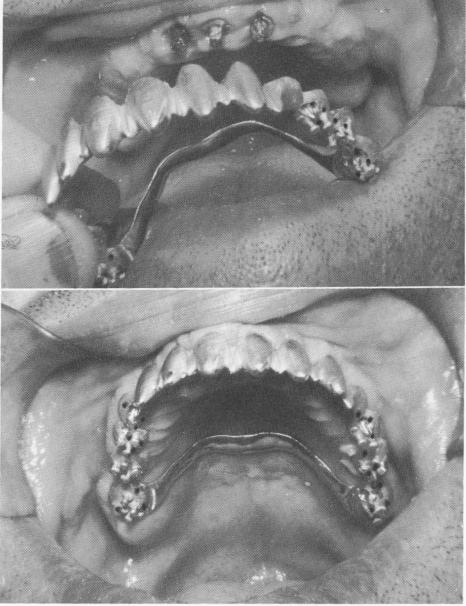 1 Scalloped gold template placed on the upper jaw