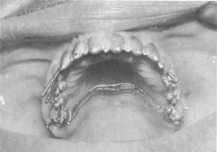 2 Pin implants drilled through maxillary scalloped template