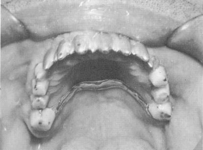 3 Acrylic cores secure dental pins & prepared for full crown restoration