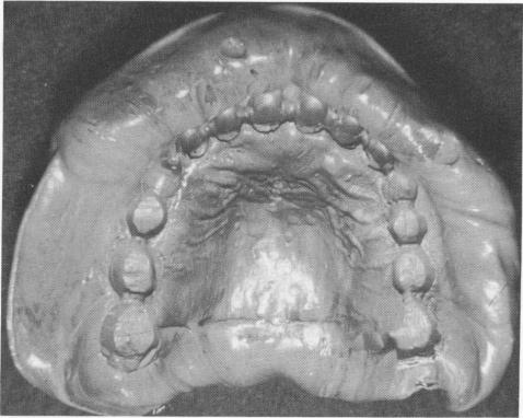 4 Maxillary full arch rubber base impression taken