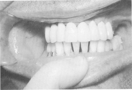 1 Temporary maxillary anterior acrylic splint fitted with soft cement
