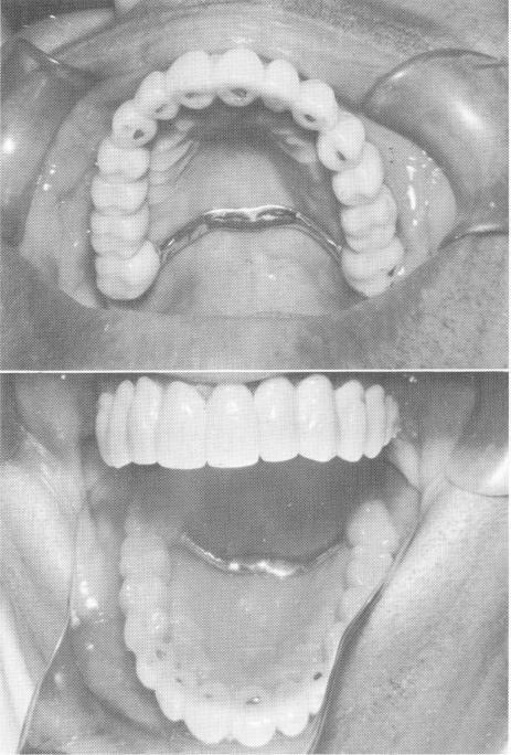 2 Completed acrylic over gold maxillary full arch fixed denture