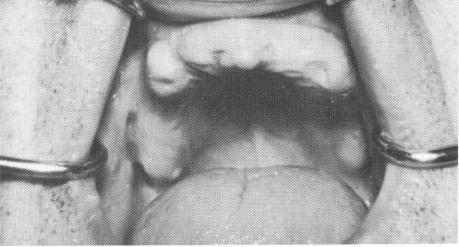 3 Edentulous maxilla with adequate anterior bone