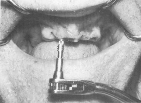 1 Ventplant screwed into maxillary arch