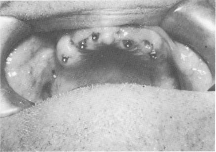 2 Five internally threaded ventplants seen in upper dental arch