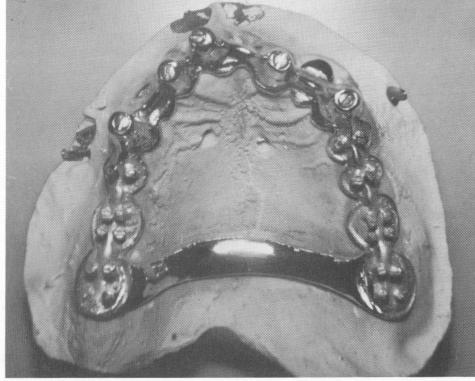 4 Picture of master stone model, maxillary template & small set screws 