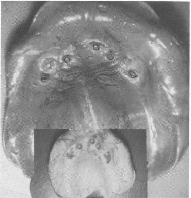 5 Template screwed into internal threads of dental implant shafts