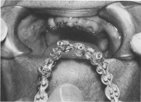 1 Maxillary template fitted in the mouth