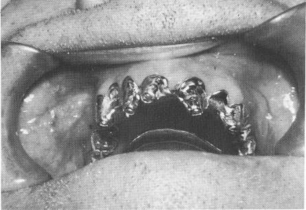 2 Maxillary template secured to implants by screwing small set screws