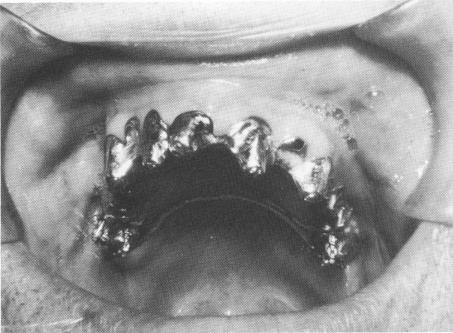 3 Dental pin implants avoiding low floor of the maxillary sinus