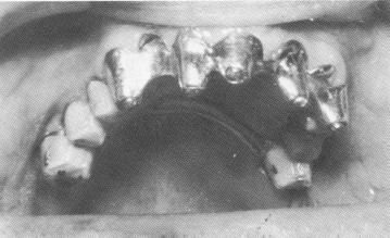 4 Maxillary pin implants locked to each other with acrylic