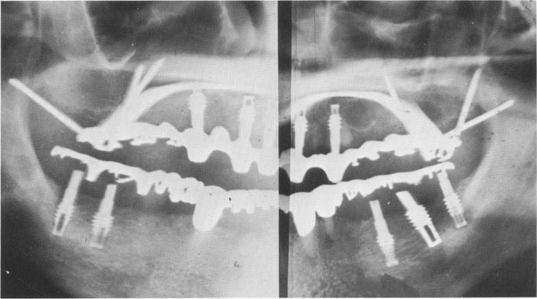 1 Ventplant, triplants, scalloped template & palatal connecting bar