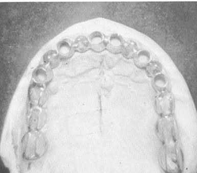 2 Scalloped tube template with double rails on maxillary quadrants