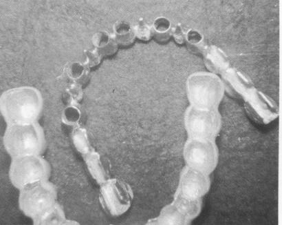 3 Maxillary superstructure cast & upper arch template done