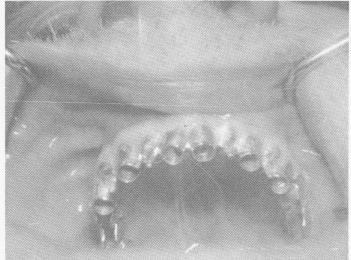1 Template fitted over maxillary edentulous arch