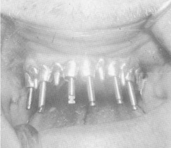 2 Maxillary implant ends not extending beyond occlusal rims of tubes