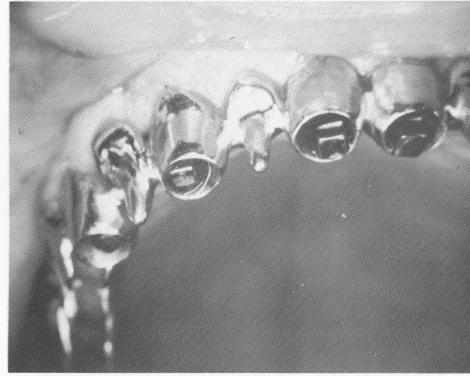 3 Burs used with maxillary template in place