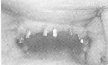 4 Ventplants in maxillary arch are closely parallel to one another