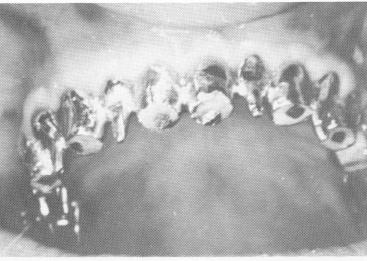 5 Dental pin implants drilled through template`s double railed portion