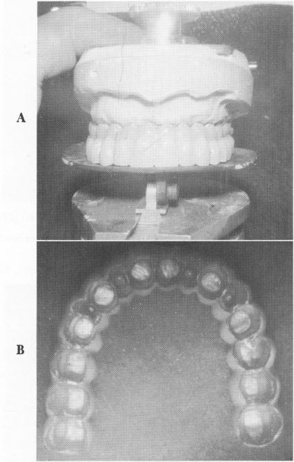 1 Maxillary superstructure balanced on Special occlusal template 