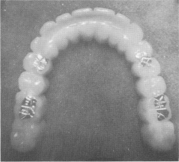 2 Internal side of the maxillary superstructure